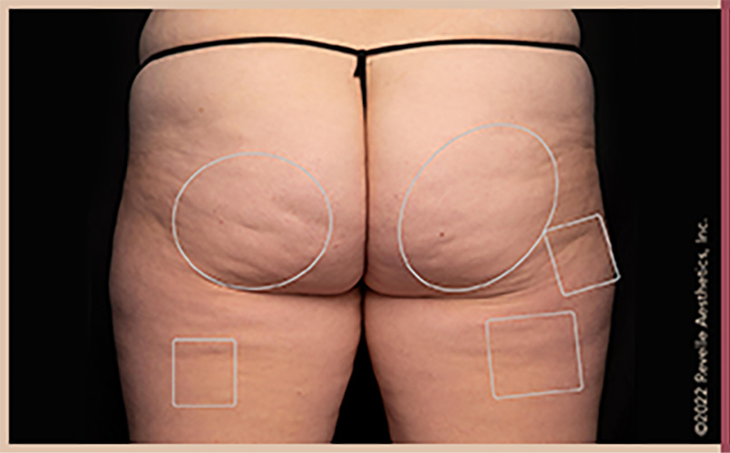 Aveli Cellulite Reduction Before & After Image