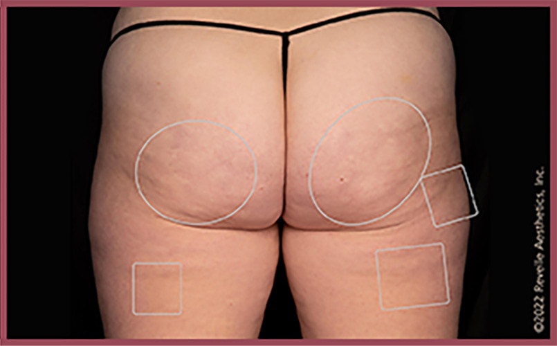 Aveli Cellulite Reduction Before & After Image