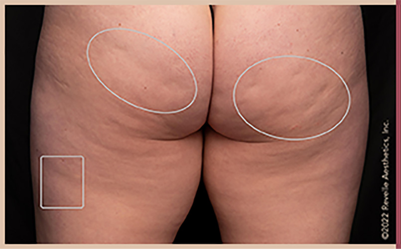Aveli Cellulite Reduction Before & After Image