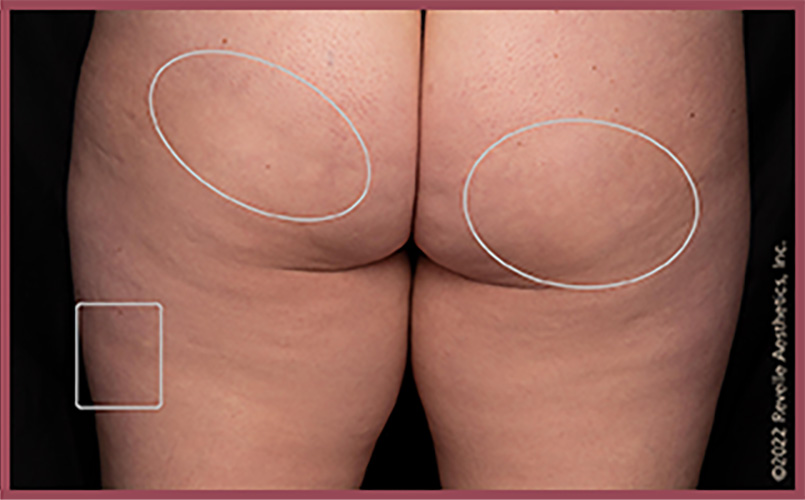 Aveli Cellulite Reduction Before & After Image