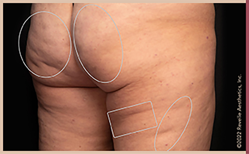 Aveli Cellulite Reduction Before & After Image