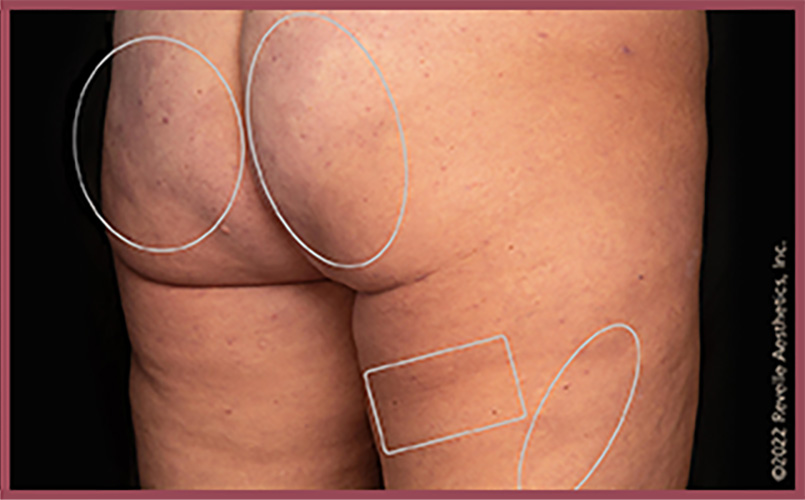 Aveli Cellulite Reduction Before & After Image