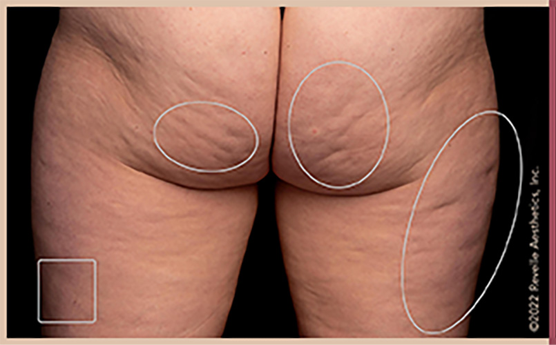 Aveli Cellulite Reduction Before & After Image