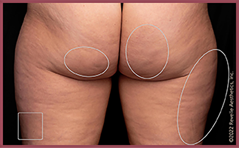 Aveli Cellulite Reduction Before & After Image