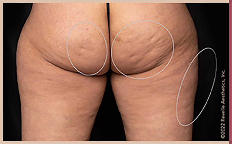 Aveli Cellulite Reduction Before & After Image