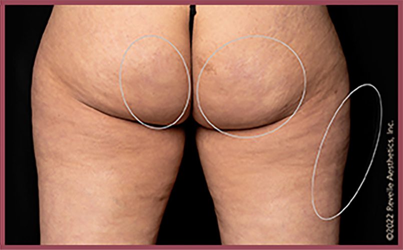 Aveli Cellulite Reduction Before & After Image