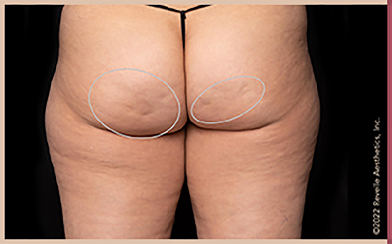 Aveli Cellulite Reduction Before & After Image