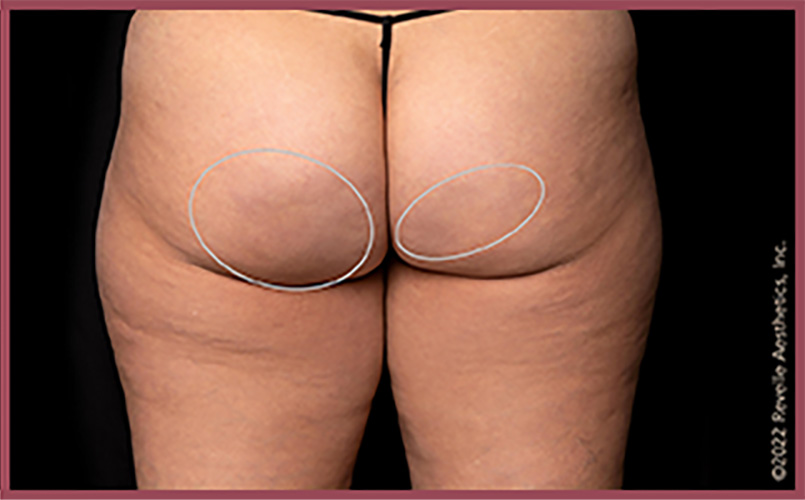 Aveli Cellulite Reduction Before & After Image