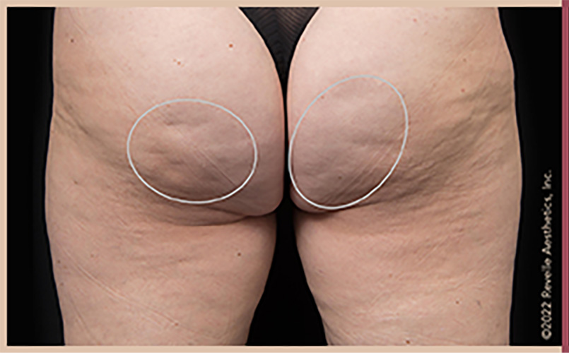 Aveli Cellulite Reduction Before & After Image