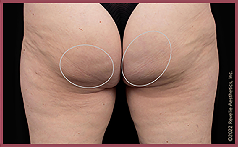 Aveli Cellulite Reduction Before & After Image