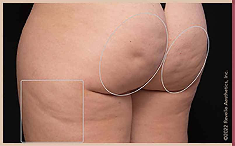 Aveli Cellulite Reduction Before & After Image