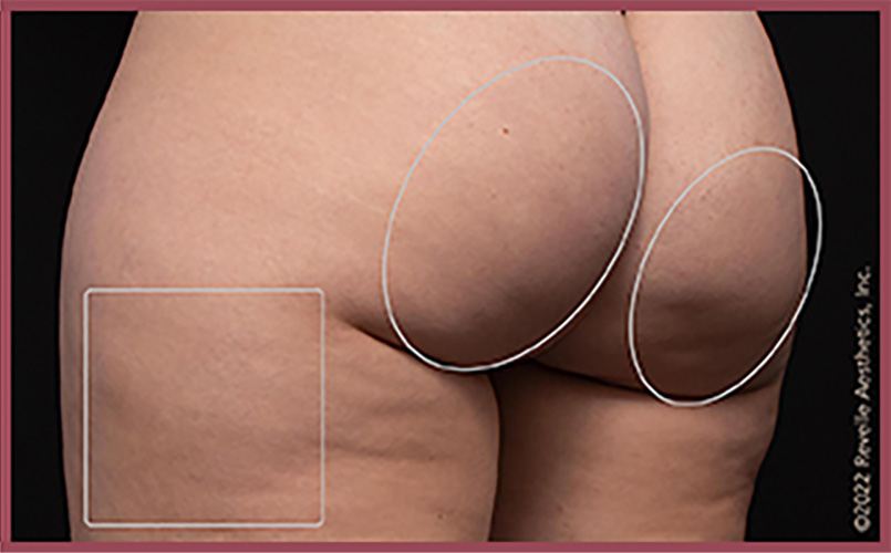 Aveli Cellulite Reduction Before & After Image