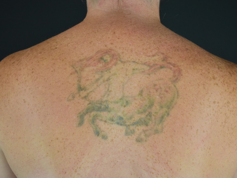 Liposuction Before & After Image