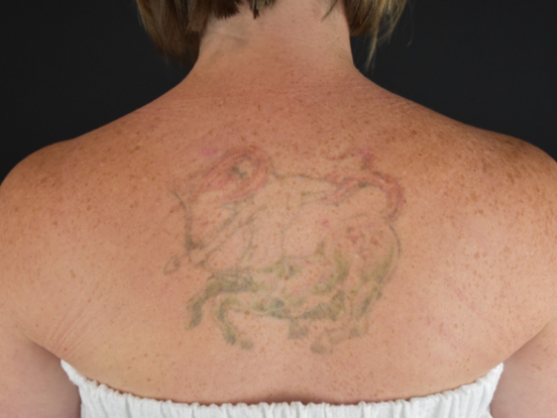 Liposuction Before & After Image