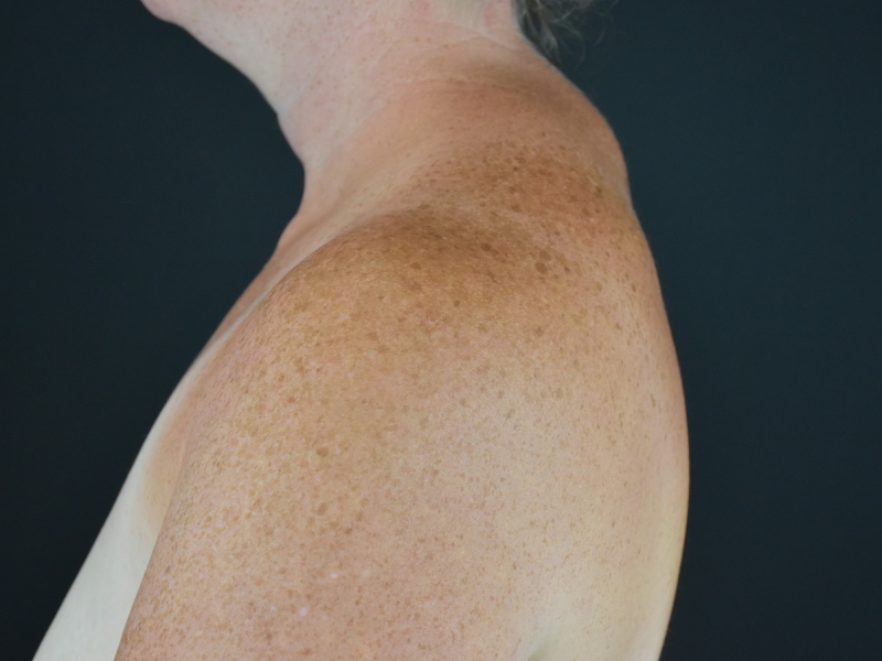 Liposuction Before & After Image