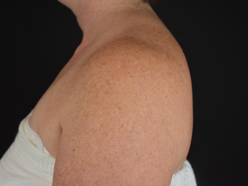 Liposuction Before & After Image