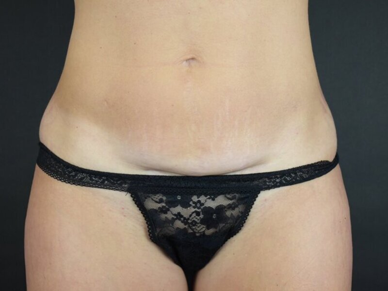 Scar Revision Before & After Image