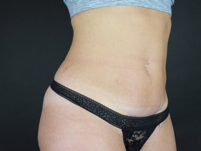 Scar Revision Before & After Image