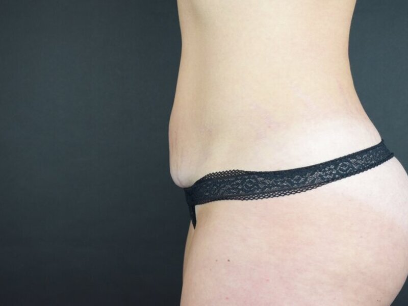 Scar Revision Before & After Image