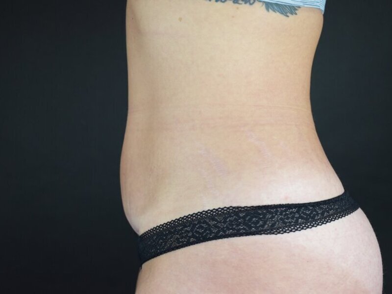 Scar Revision Before & After Image