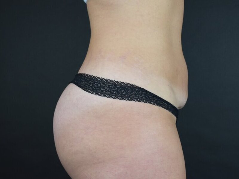 Scar Revision Before & After Image