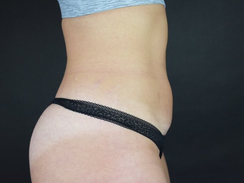 Scar Revision Before & After Image