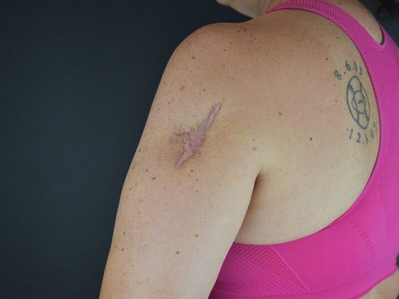 Scar Revision Before & After Image
