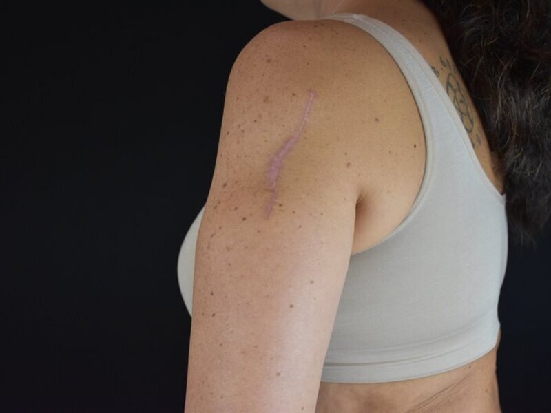 Scar Revision Before & After Image