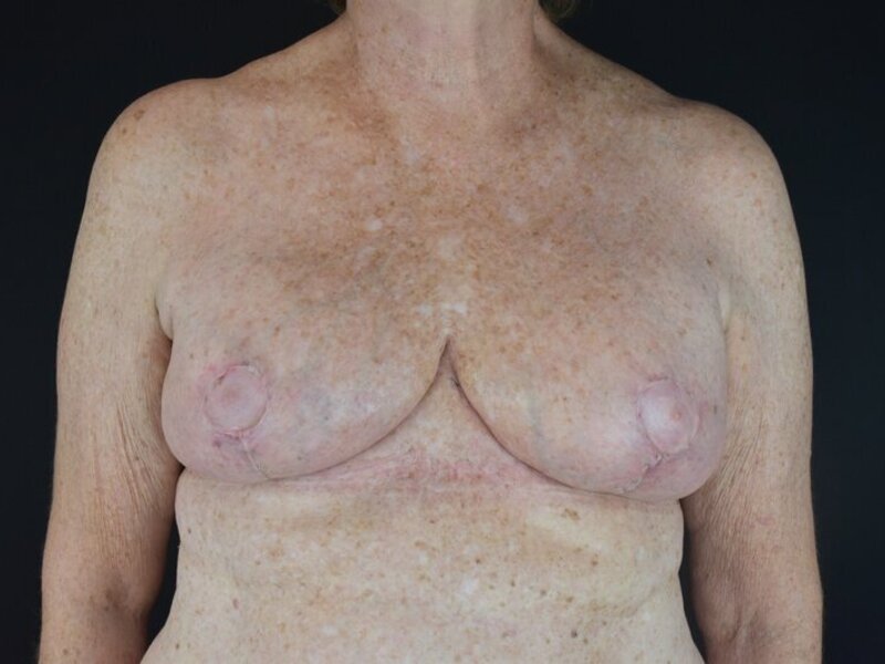 Breast Implant Revision Before & After Image