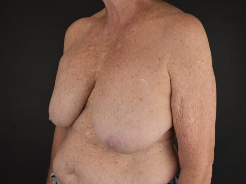 Breast Implant Revision Before & After Image