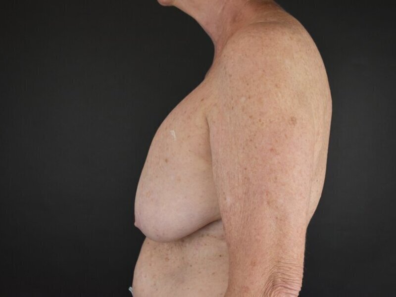 Breast Implant Revision Before & After Image