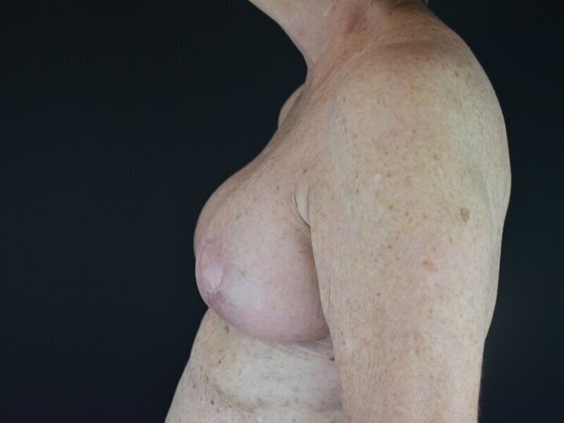 Breast Implant Revision Before & After Image