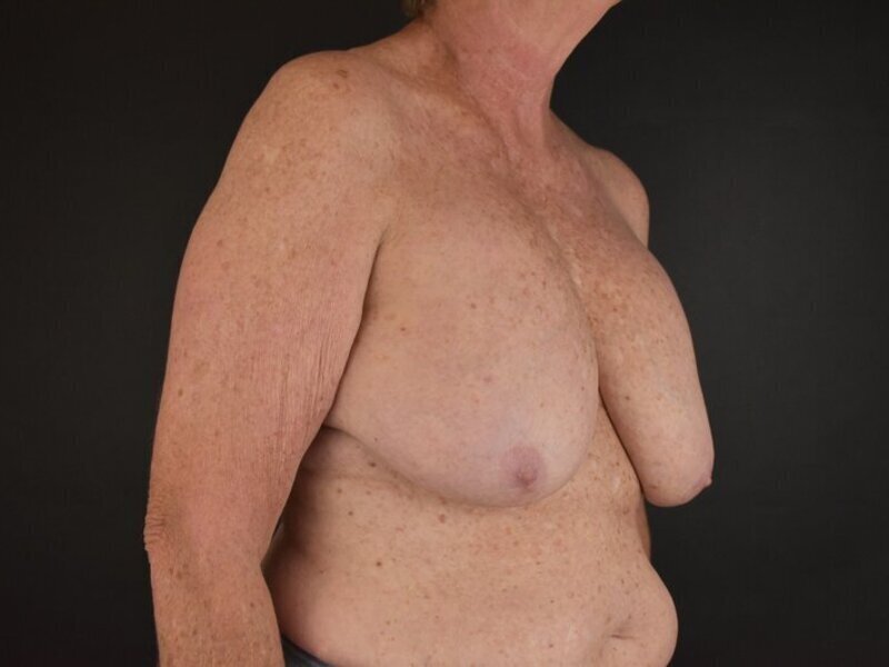 Breast Implant Revision Before & After Image