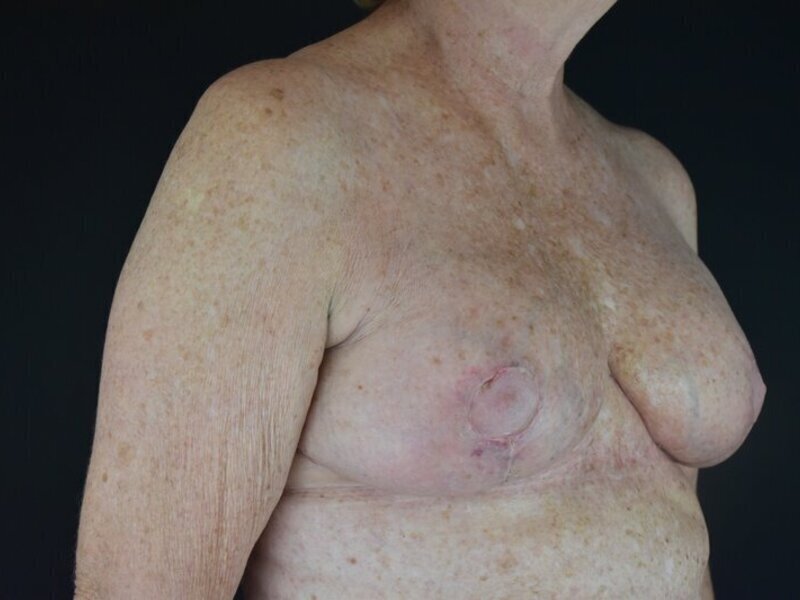 Breast Implant Revision Before & After Image