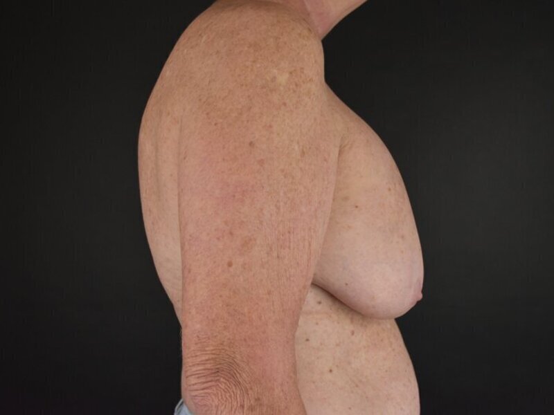 Breast Implant Revision Before & After Image