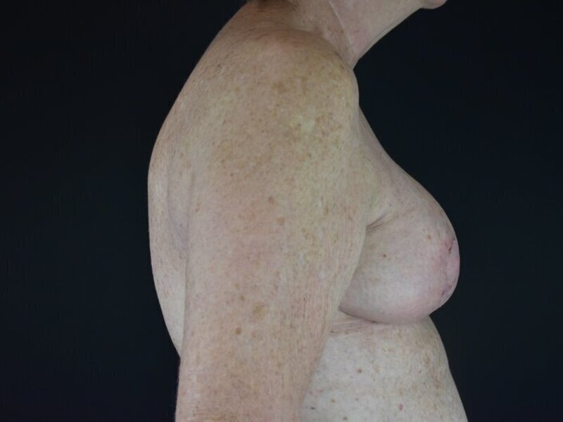 Breast Implant Revision Before & After Image