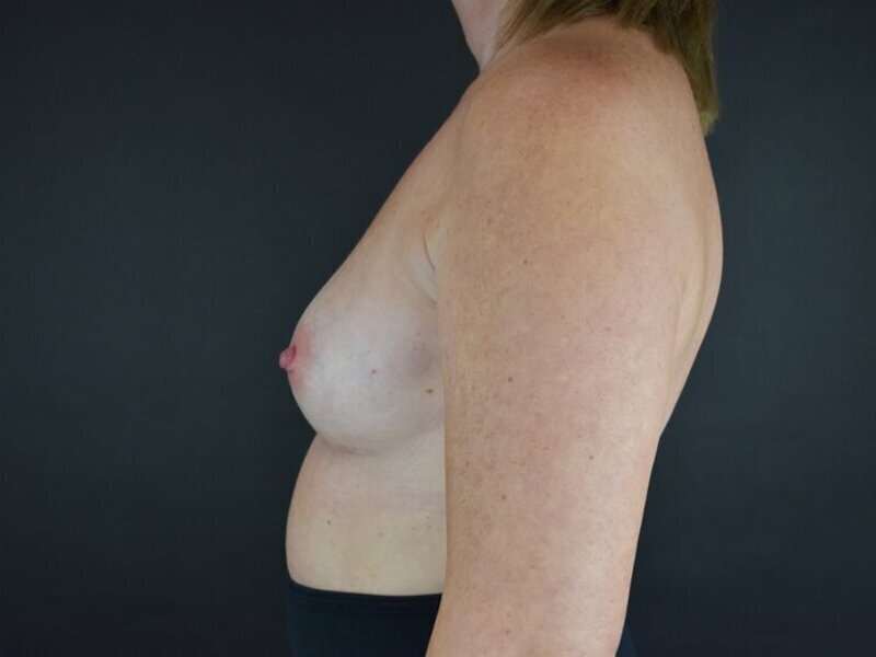 Breast Implant Revision Before & After Image