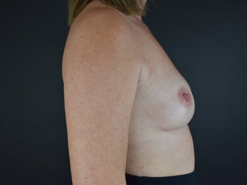 Breast Implant Revision Before & After Image
