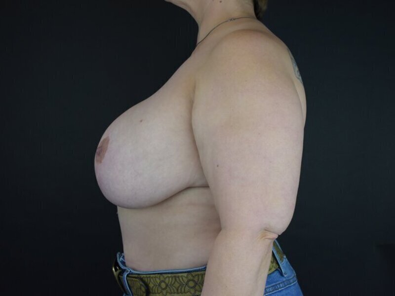 Breast Implant Revision Before & After Image