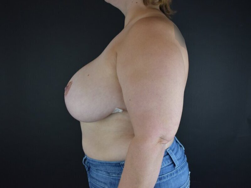 Breast Implant Revision Before & After Image