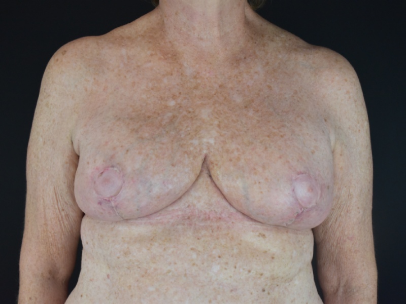 Breast Lift with Mastopexy Before & After Image