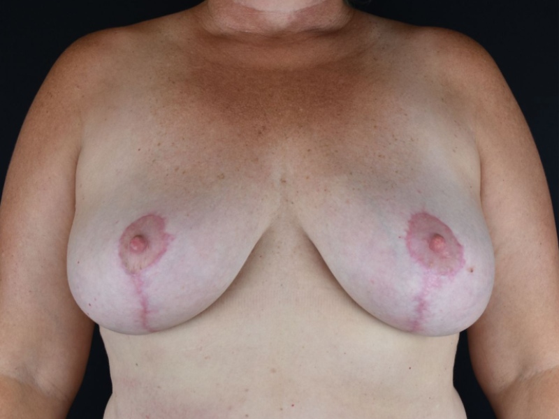 Breast Lift with Mastopexy Before & After Image