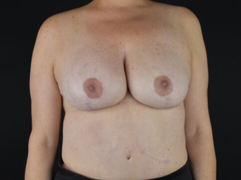 Breast Reconstruction Before & After Image