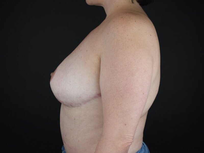 Breast Reconstruction Before & After Image