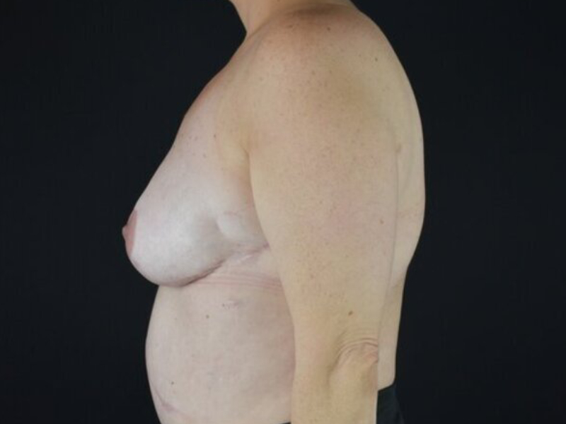 Breast Reconstruction Before & After Image