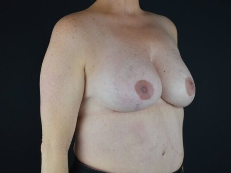 Breast Reconstruction Before & After Image