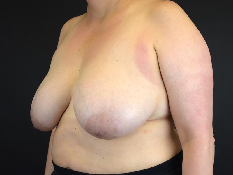 Breast Reduction Before & After Image