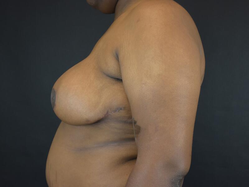 Breast Reduction Before & After Image